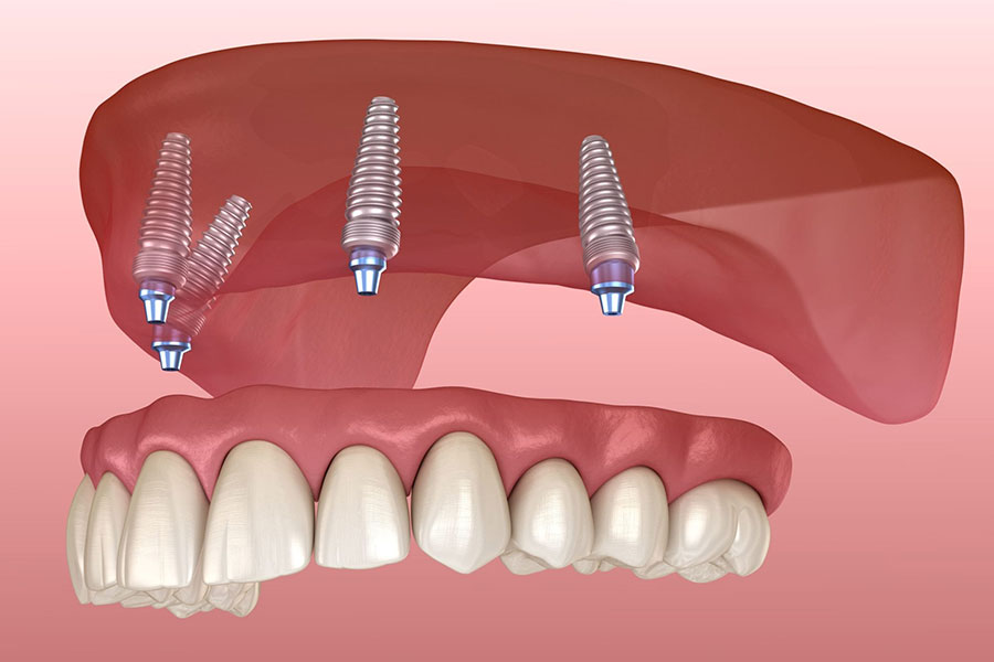 Implant Retained Dentures - Mount Prospect Smiles